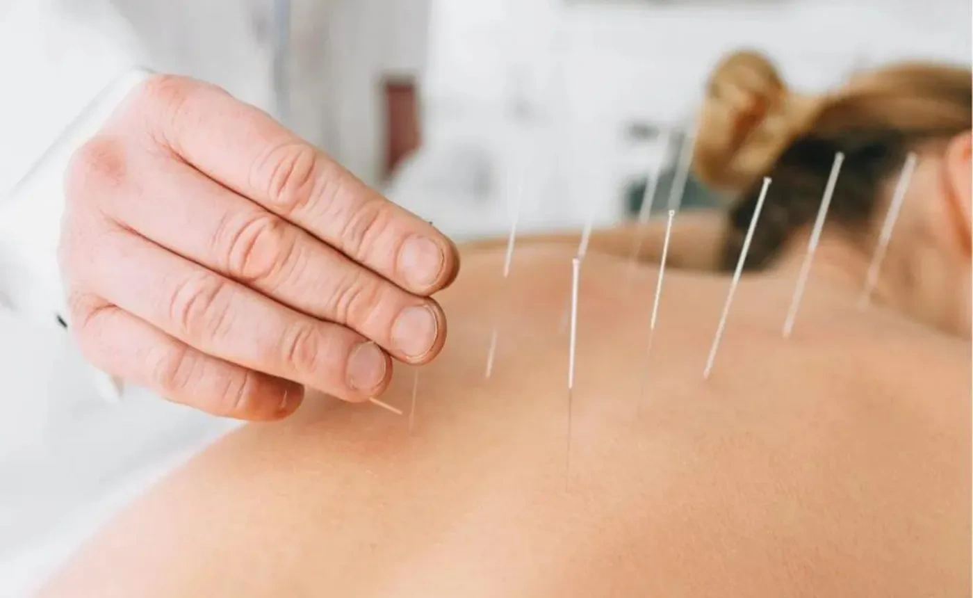 Cluster of dry needles in patient's back