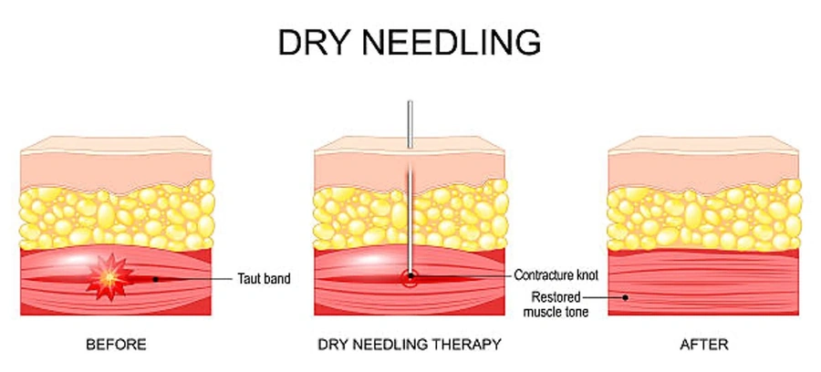 Dry needling skin diagram