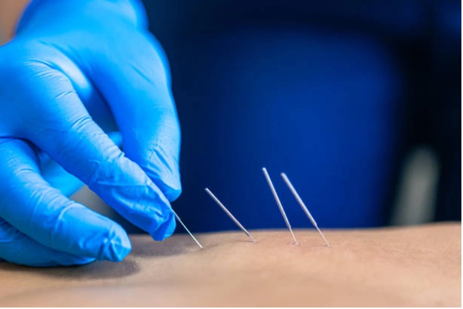Administering dry needling