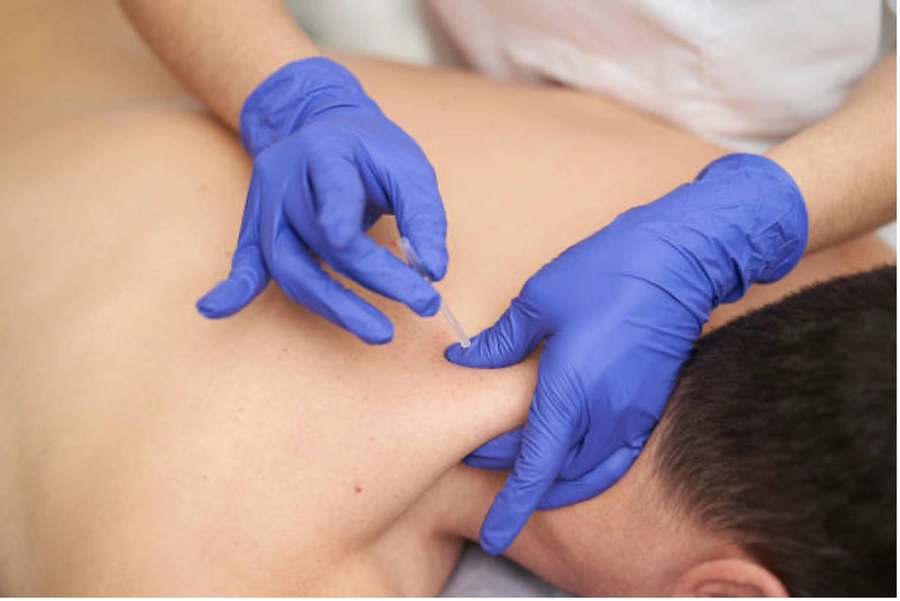 Patient receiving dry needling treatment